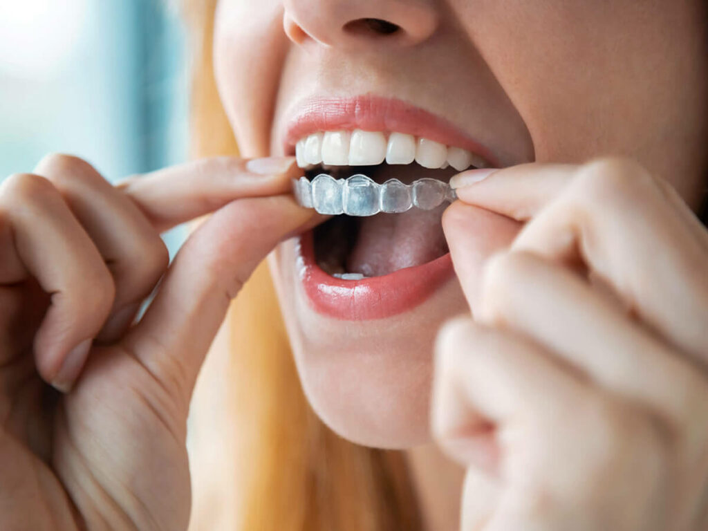 image of a girl putting clear aligners in