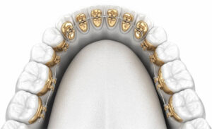 graphic of lingual braces on bottom teeth
