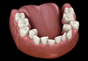 digital model of overcrowded teeth